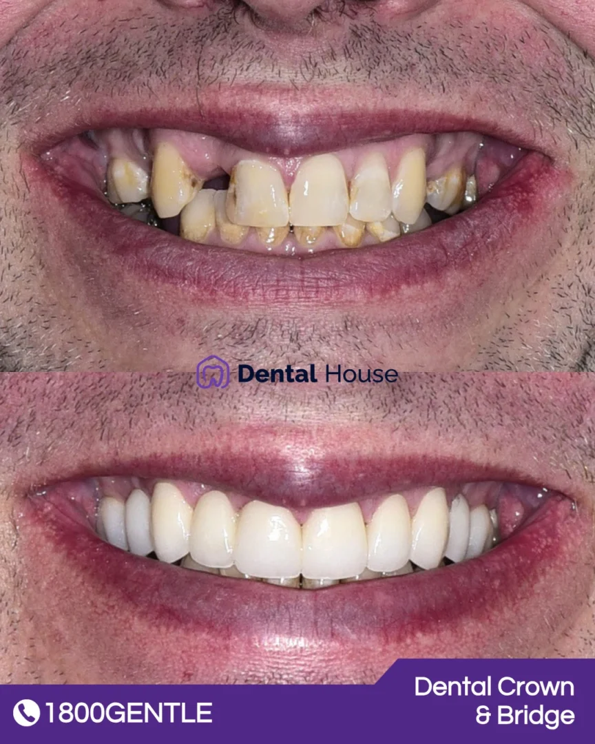 Dental Crown & Bridge