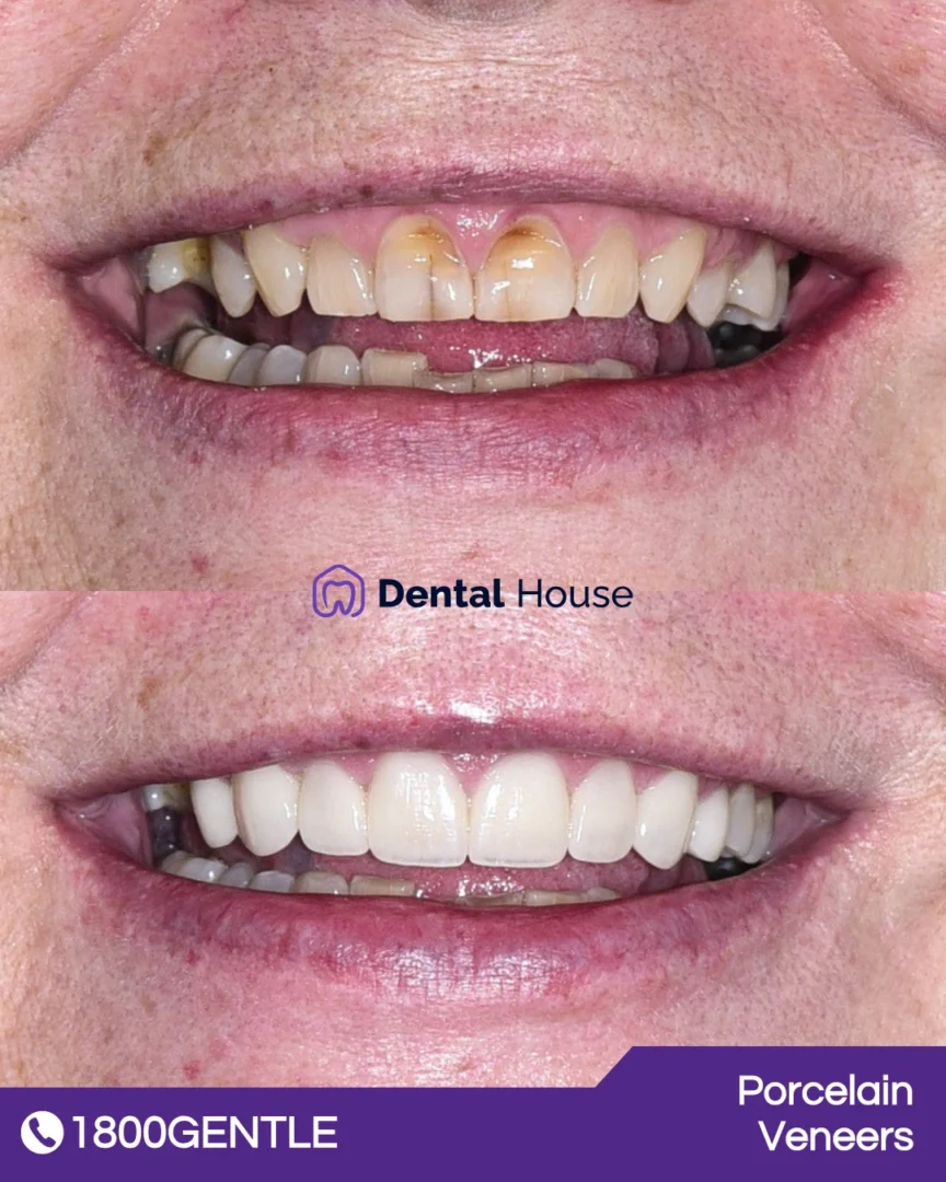 Dental Veneers